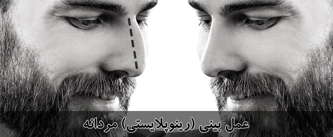 انواع جراحی بینی 4 Men Rhinoplasty2
