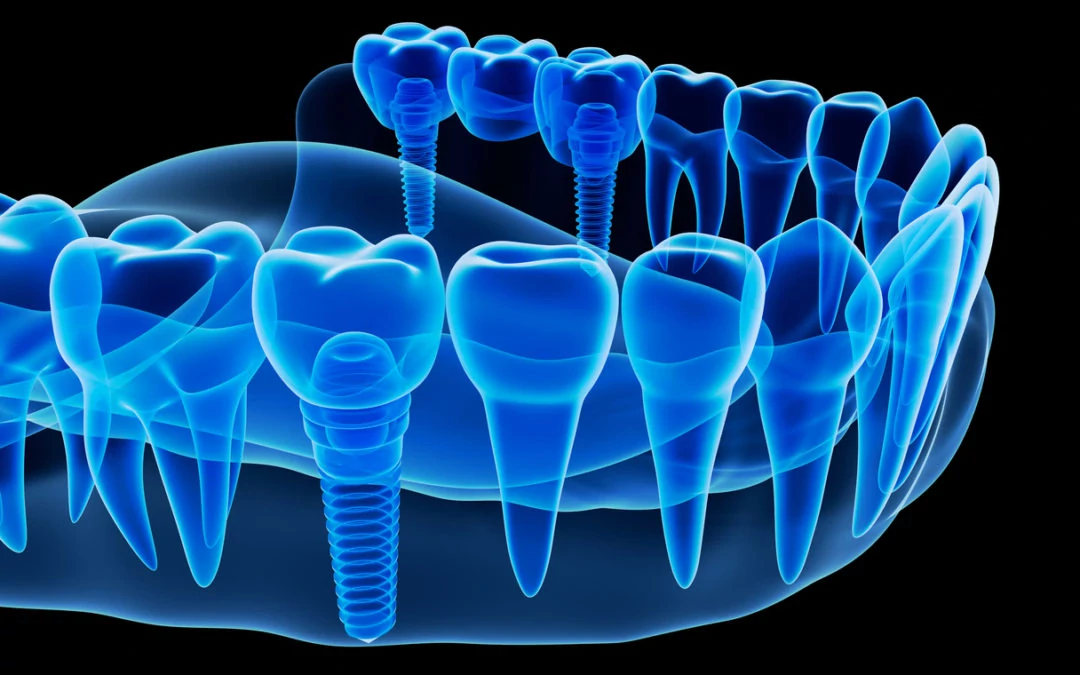 تاثیر کیفیت استخوان بر سرعت ایمپلنت دیجیتال
