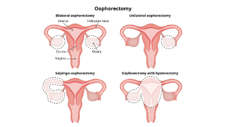 اووفورکتومی یا جراحی برداشتن تخمدان چیست؟