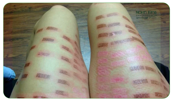 بهترین دستگاه لیزر موهای زائد در مشهد | راهنمای جامع 4 معایب و عوارض احتمالی لیزر مو